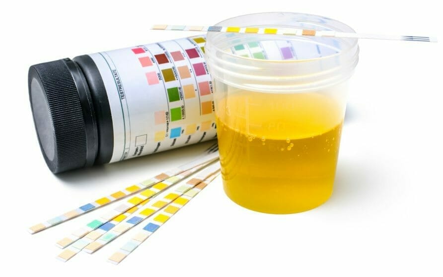 urine in a cup with strips