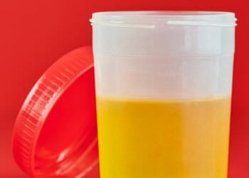 Urine in a cup