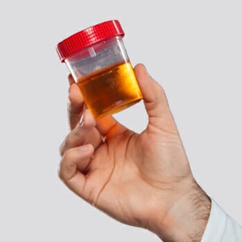 A reddish urine sample being held by a scientist
