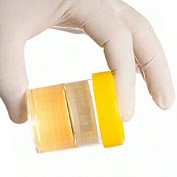 A urine sample being held by someone