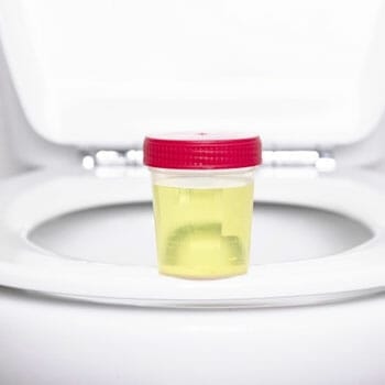 A bottle filled with urine sample on a toilet bowl