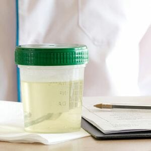 A urine sample in a sealed container for urine test