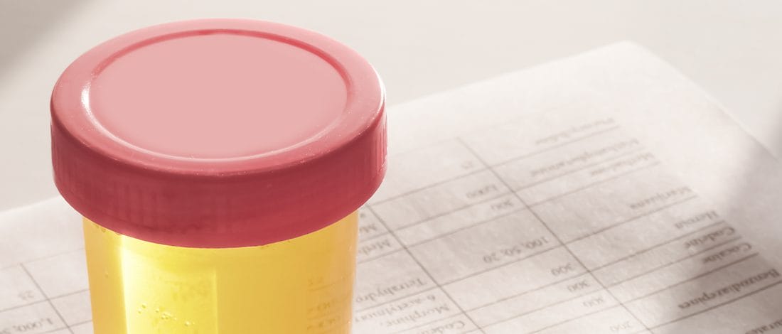 What Does Diluted Urine Look Like? Urine plastic container