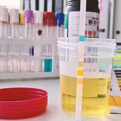 A beaker of urine in a lab