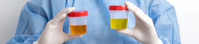 A doctor holding two jars of urine samples
