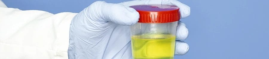 A person holding a jar of urine