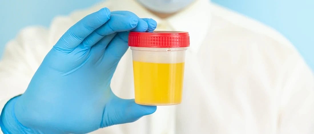 How Many Ounces of Urine is Needed for a Drug Test (4 Tips) A doctor holding a jar of urine for drug testing
