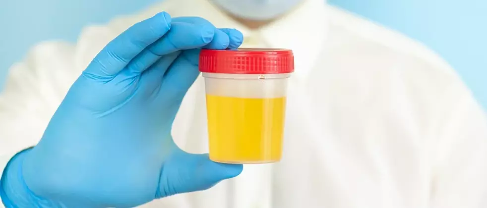 A doctor holding a jar of urine for drug testing
